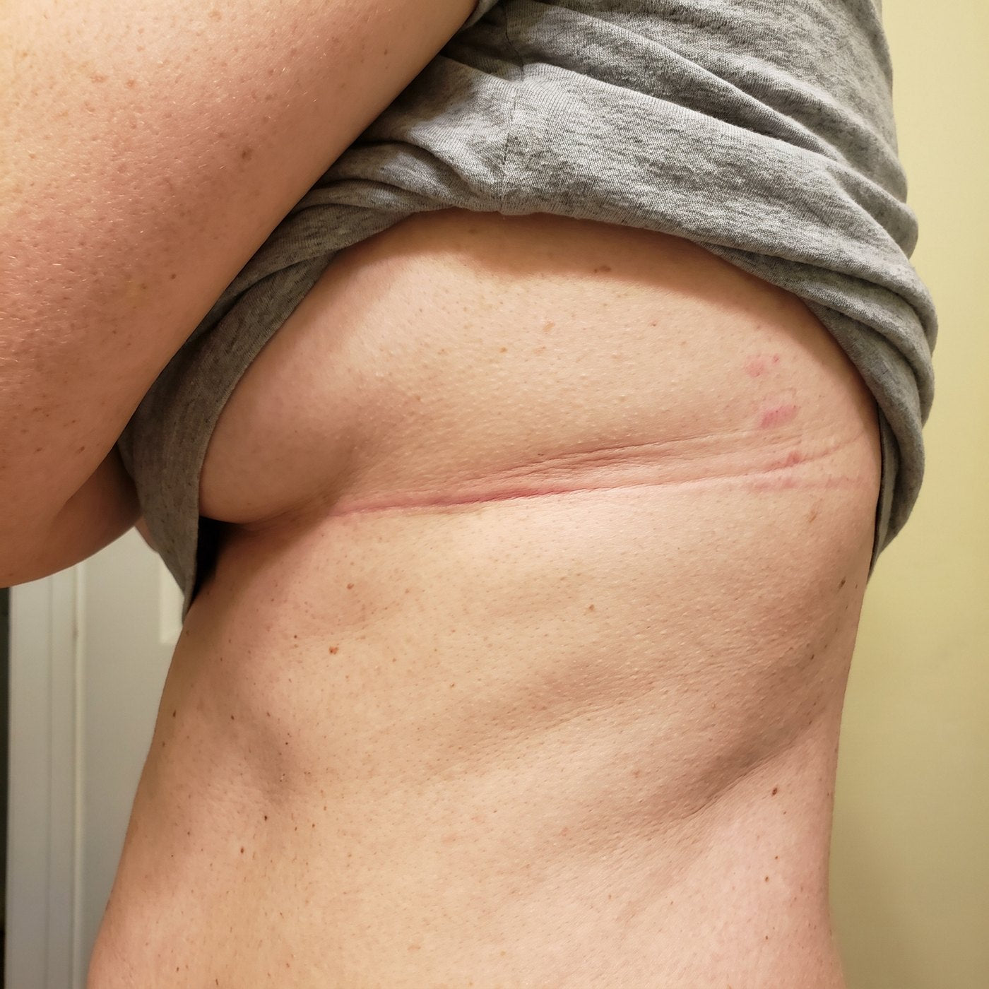 Red band marks left on the ribs by a bra
